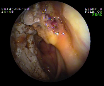 Endoscopia bolsa gutural micosis caballo